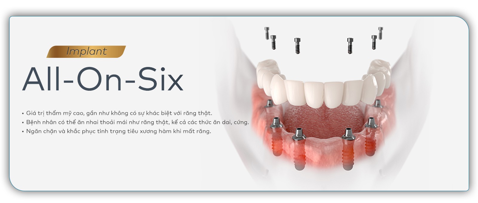 Hình ảnh minh họa All on - 6