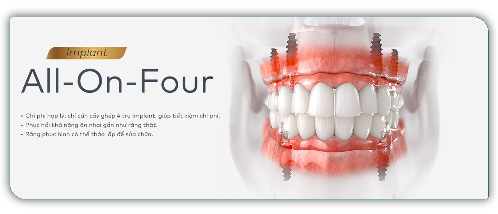 So sánh All on - 4 và All on - 6