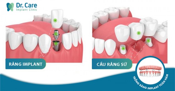 NÊN LÀM CẦU RĂNG SỨ HAY CẤY GHÉP IMPLANT KHI MẤT RĂNG?