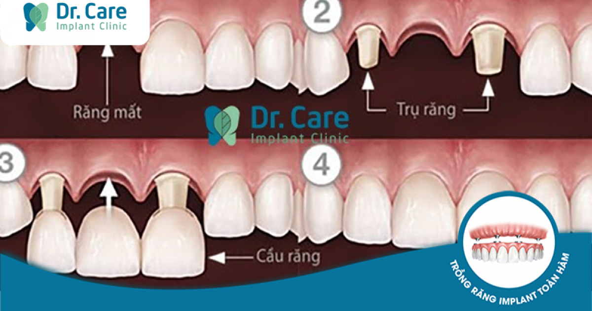 Quy trình làm cầu răng sứ như thế nào, có lâu không?