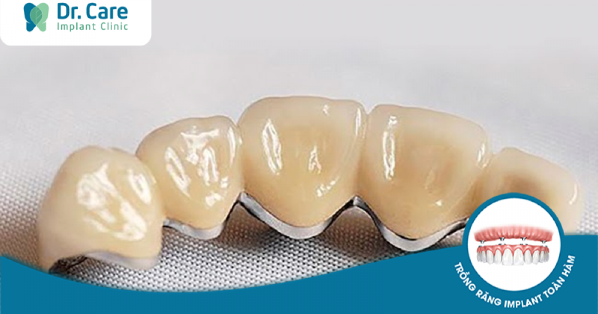 Cầu răng sứ titan là gì? Ưu nhược điểm như thế nào?