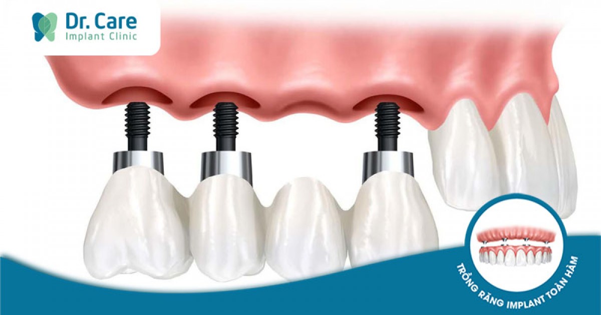 7 giải pháp trồng răng Implant tiết kiệm cho người mất nhiều răng