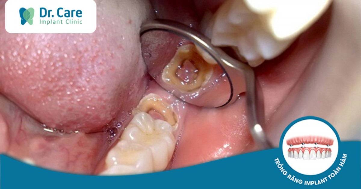 Răng khôn bị sâu: Cách trị sâu và giảm đau nhức hiệu quả