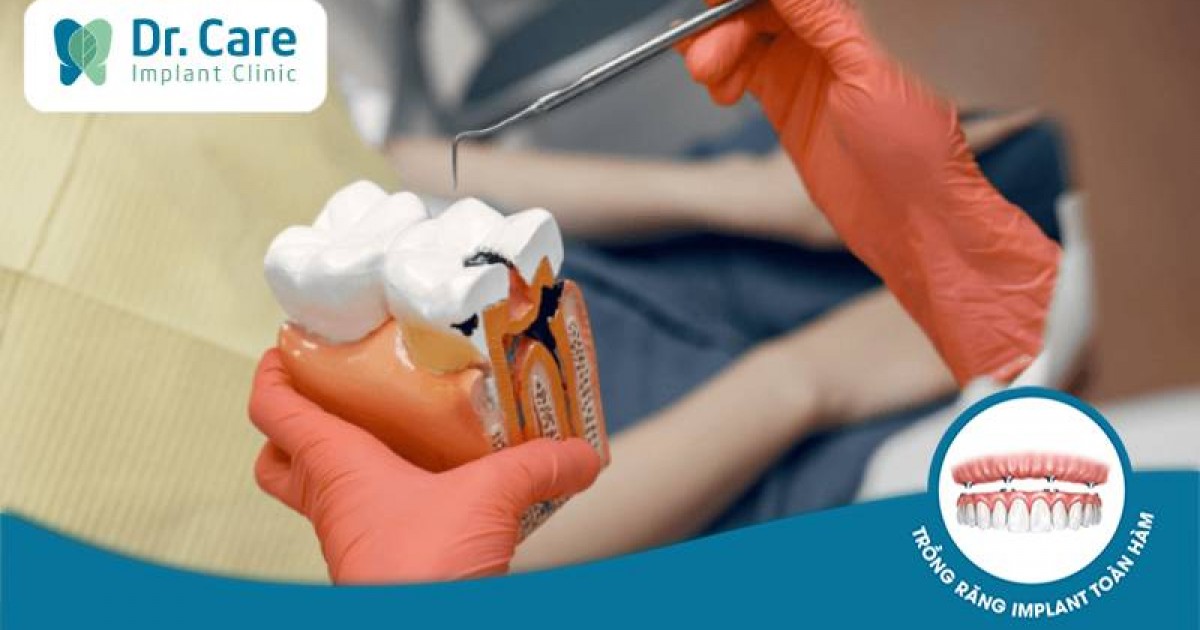 Tủy răng bị thối - Nguyên nhân và cách điều trị hiệu quả