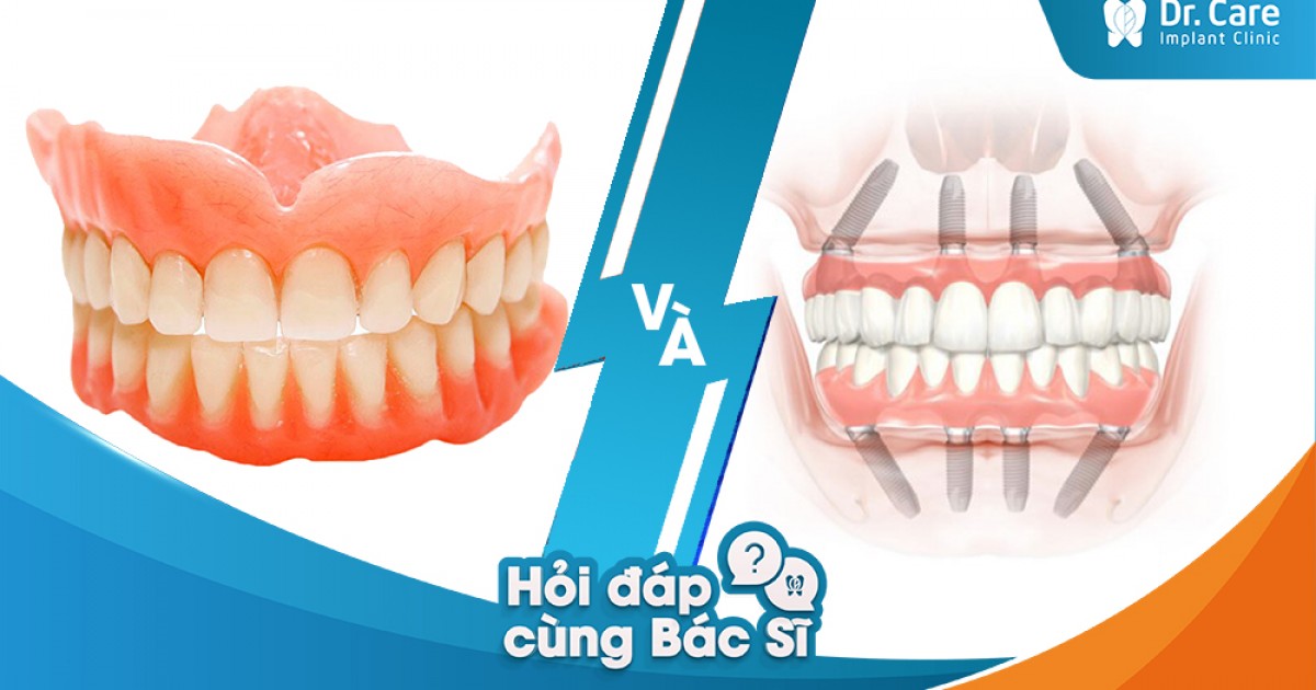Phương pháp trồng răng Implant toàn hàm và hàm giả tháo lắp có khác gì nhau không?
