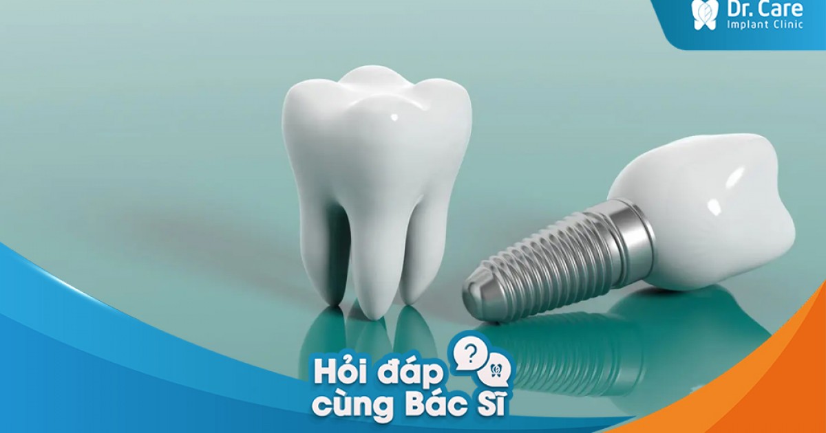 Trụ Implant xài được bao lâu? Sau khi trồng trụ Implant có phải thay mới như cầu răng sứ hay hàm tháo lắp không