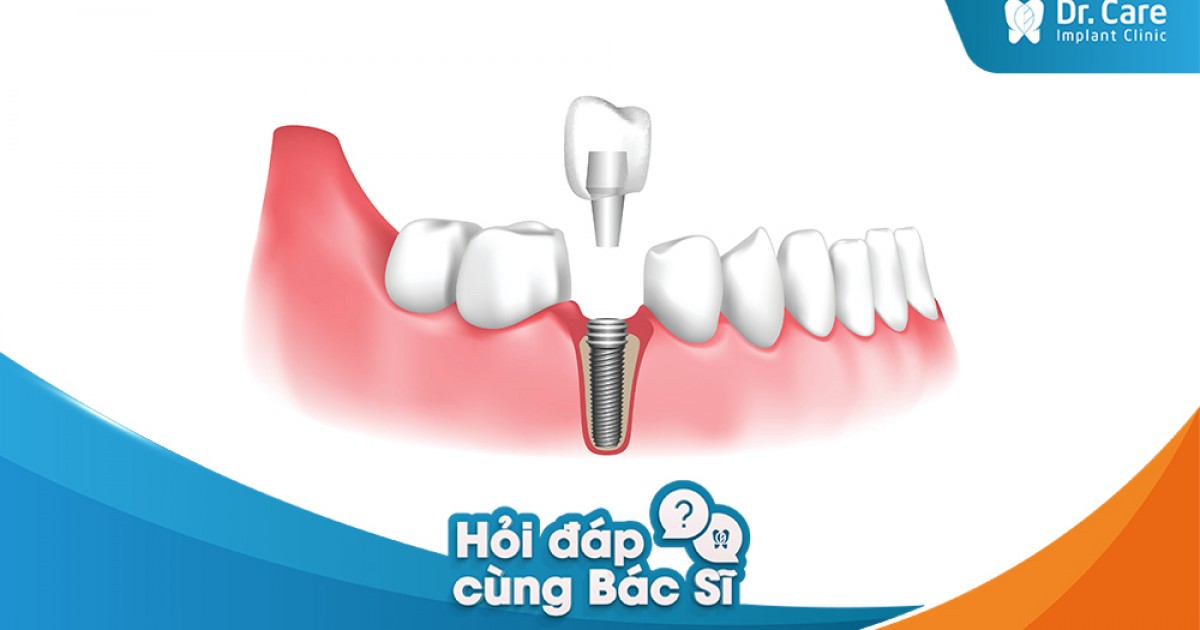 Mất nhiều răng liền kề thì nên trồng trụ Implant như thế nào?