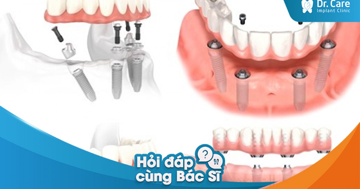 Sau khi trồng răng Implant, khoảng bao lâu thì có thể lái xe về nhà được?