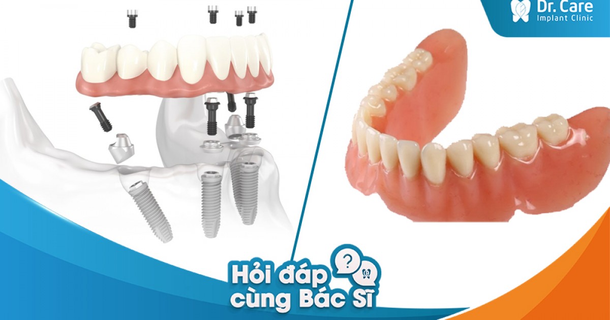 Sau khi trồng một khoảng thời gian, có phải thay thế răng khác như hàm tháo lắp không?