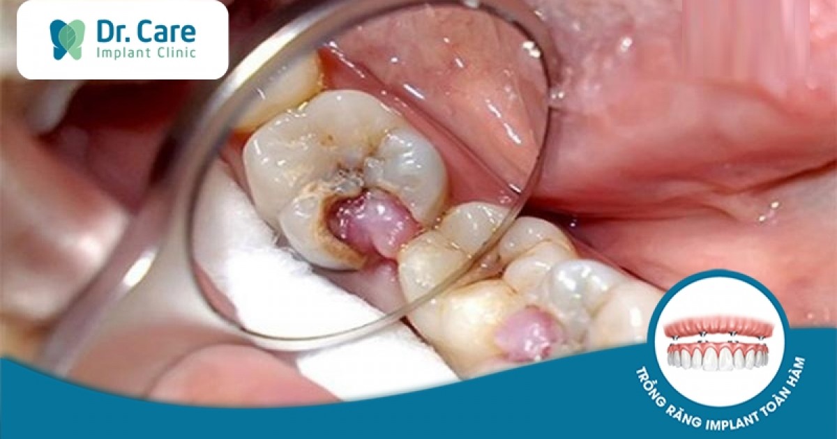 Những biểu hiện răng sâu đến tủy và cách điều trị