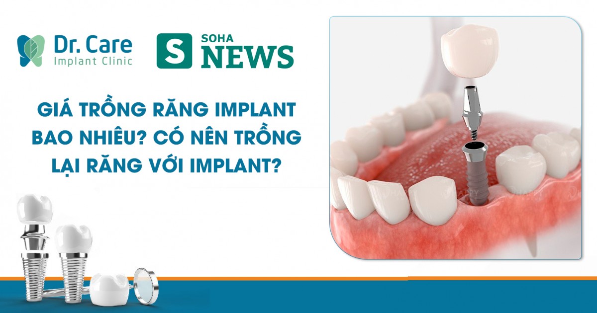 [Soha] Giá trồng răng Implant bao nhiêu? Có nên trồng lại răng với Implant?