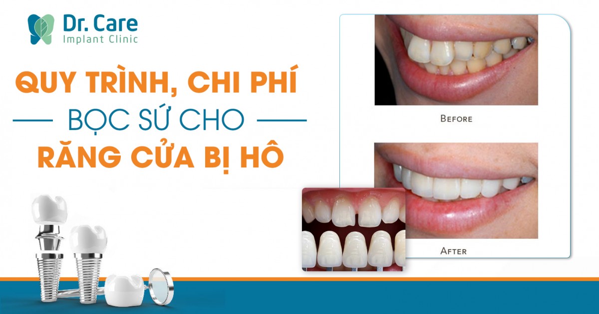 [CHI TIẾT] - Bọc sứ răng cửa bị hô có tốt không?