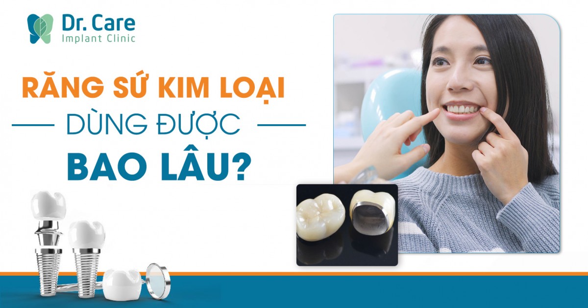 [CHI TIẾT] - Răng sứ kim loại dùng được bao lâu?