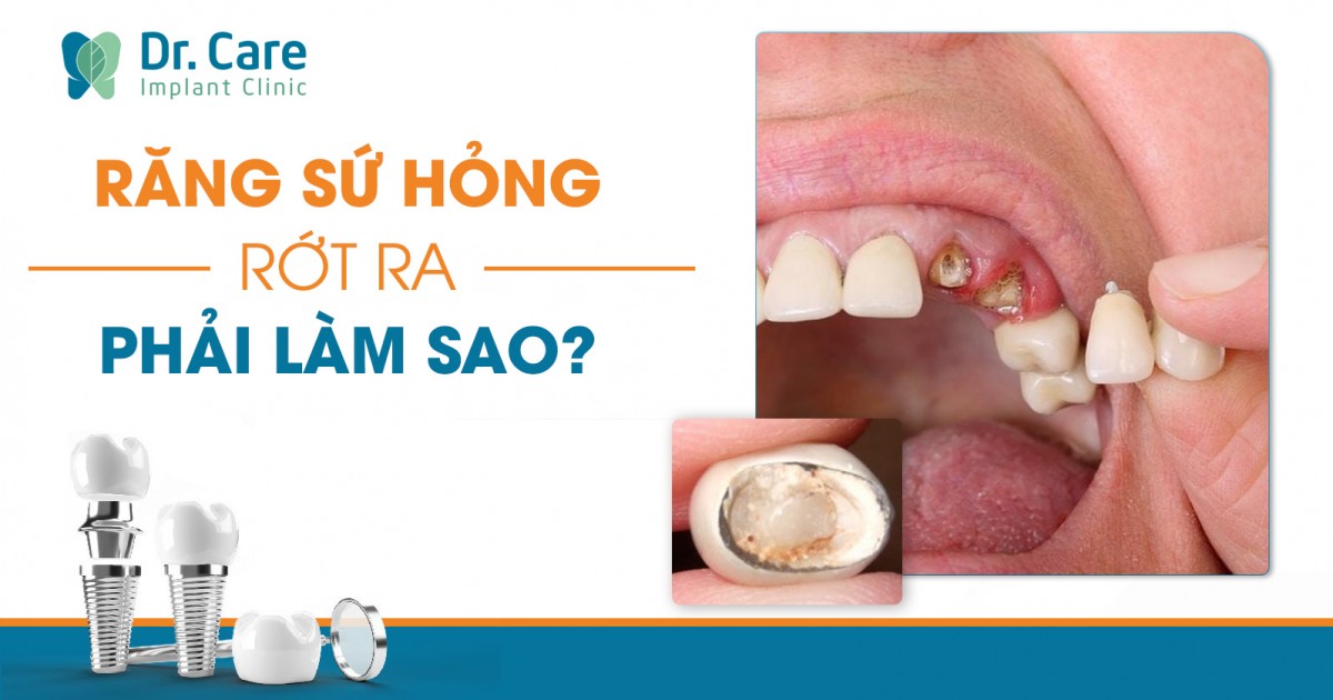 [CHI TIẾT]: Răng sứ hỏng, rớt ra phải làm sao?