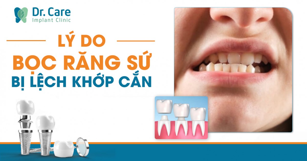 Lý do bọc răng sứ bị lệch khớp cắn là gì? Cách khắc phục hiệu quả