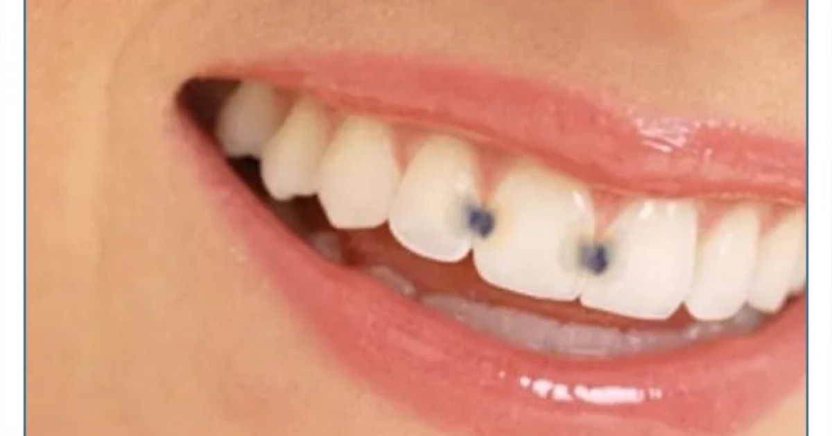 Sâu kẽ răng: Nguyên nhân, dấu hiệu và biện pháp điều trị