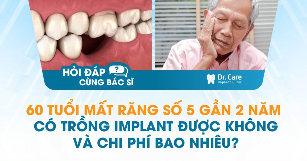 [HỎI ĐÁP BÁC SĨ] – 60 tuổi mất răng số 5 gần 2 năm có trồng Implant được không và chi phí bao nhiêu?