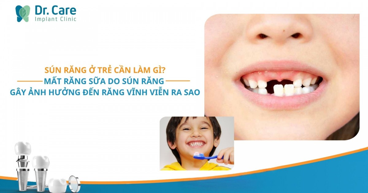 Sún răng ở trẻ cần làm gì? Mất răng sữa do sún răng gây ảnh hưởng đến răng vĩnh viễn ra sao