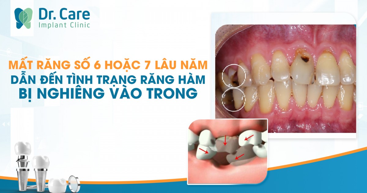 Mất răng số 6 hoặc 7 lâu năm dẫn đến tình trạng răng hàm bị nghiêng vào trong