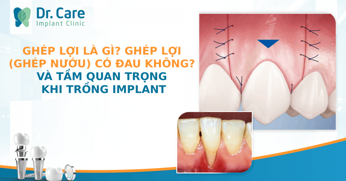 Ghép lợi là gì? Ghép lợi (ghép nướu) có đau không và tầm quan trọng khi trồng Implant