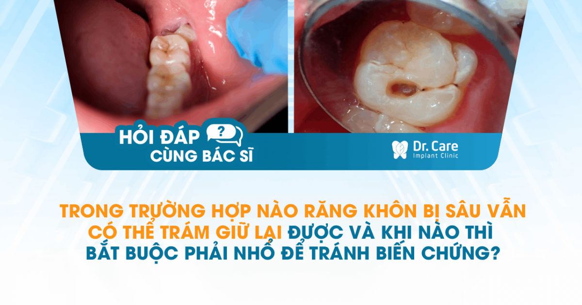[HỎI ĐÁP BÁC SĨ] - Trong trường hợp nào răng khôn bị sâu vẫn có thể trám giữ lại được và khi nào thì bắt buộc phải nhổ để tránh biến chứng