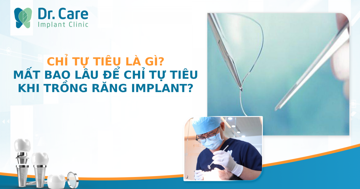 Chỉ tự tiêu là gì? Mất bao lâu để chỉ tự tiêu khi trồng răng implant?