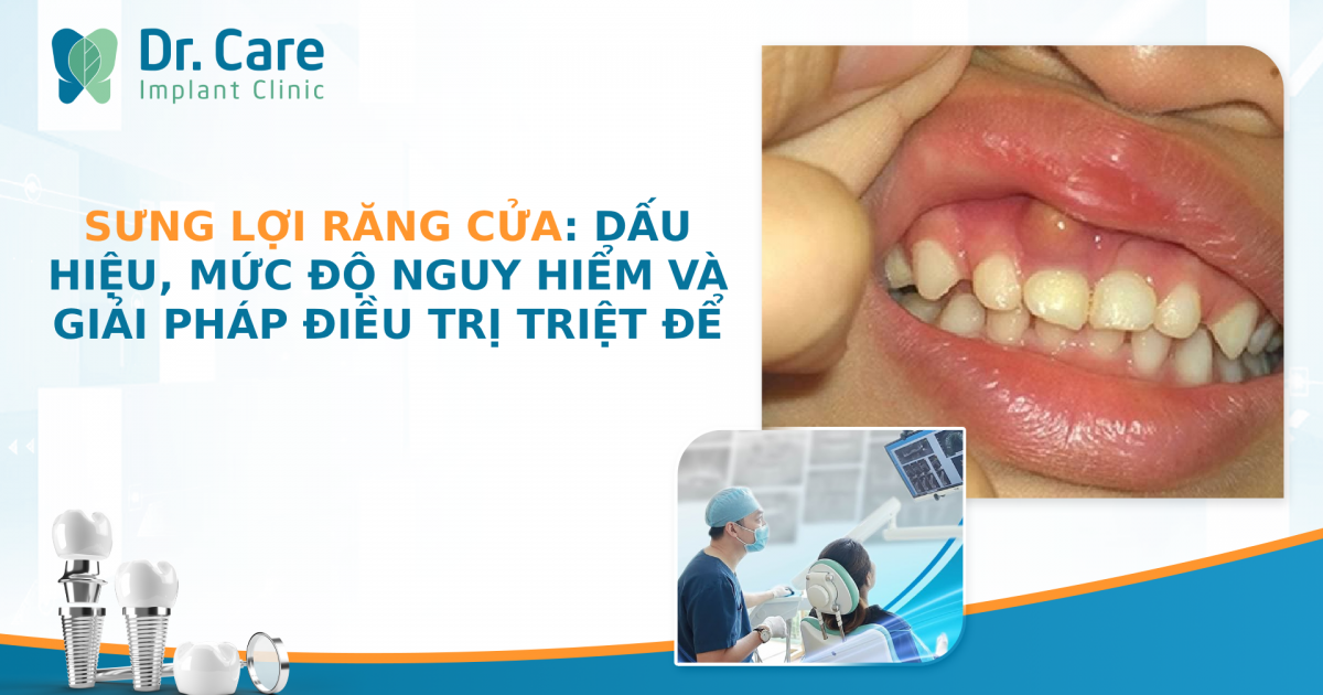 Sưng lợi răng cửa: Dấu hiệu, mức độ nguy hiểm và giải pháp điều trị triệt để