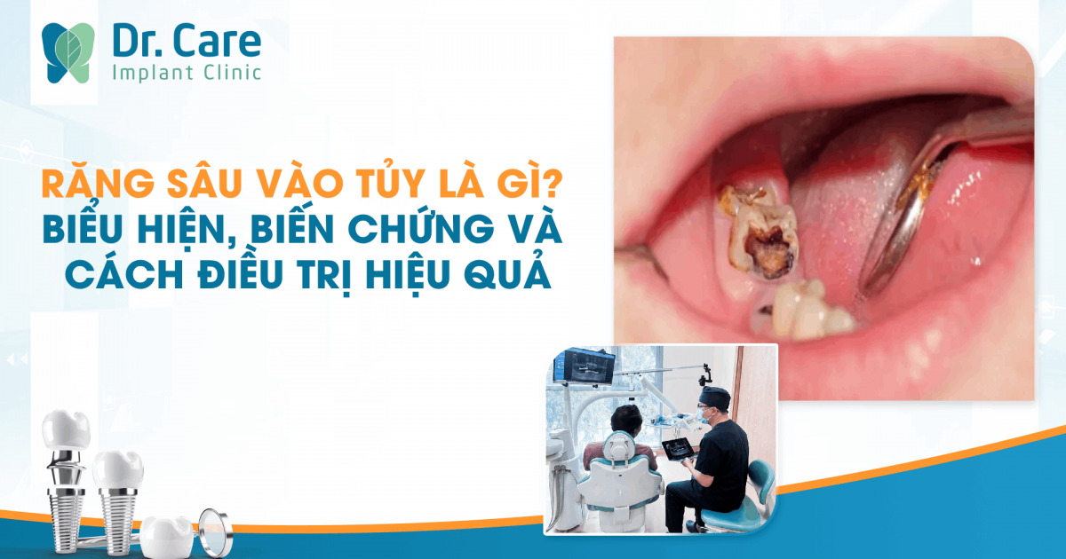 Răng sâu vào tủy là gì? Biểu hiện, biến chứng và cách điều trị hiệu quả