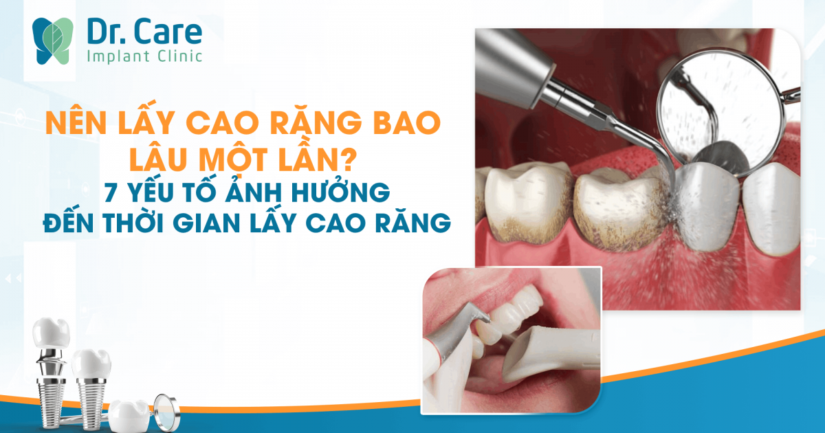 Nên Lấy Cao Răng Bao Lâu Một Lần? 7 Yếu Tố Ảnh Hưởng Đến Thời Gian Lấy Cao Răng